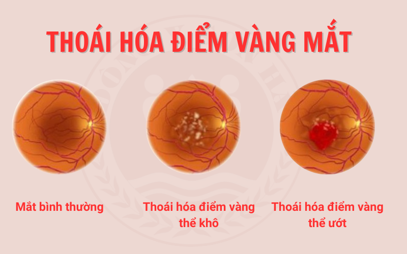Thoái hóa điểm vàng là gì? Nguyên nhân và biện pháp điều trị